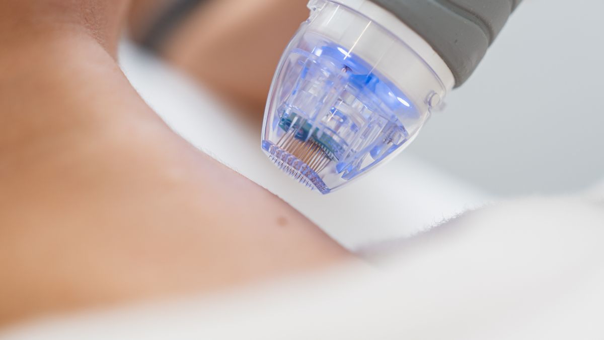 Microneedling - Tehnica inovatoare