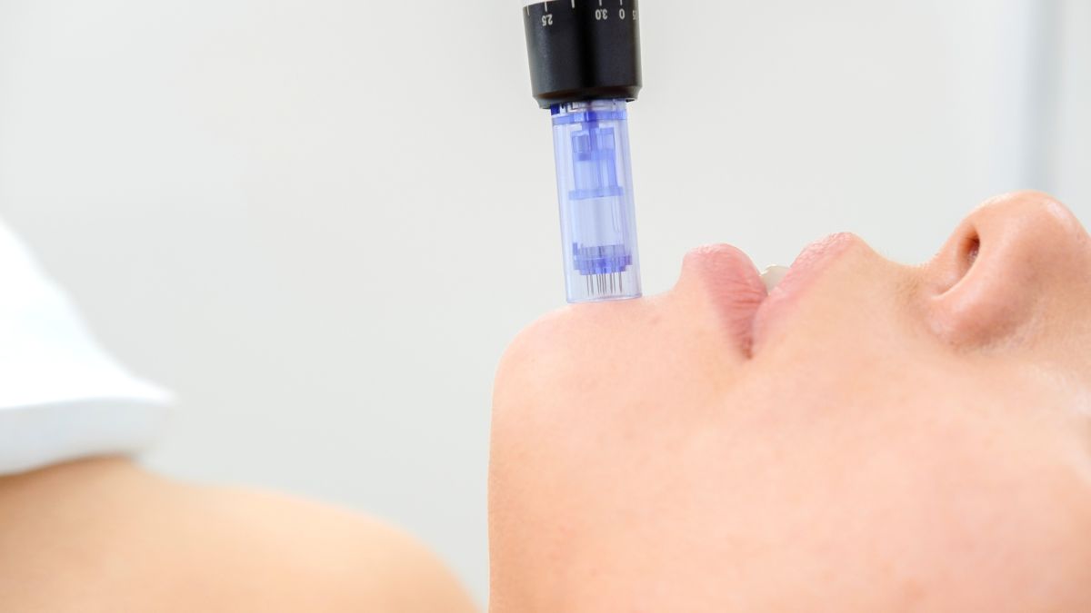 Microneedling - Avantaje