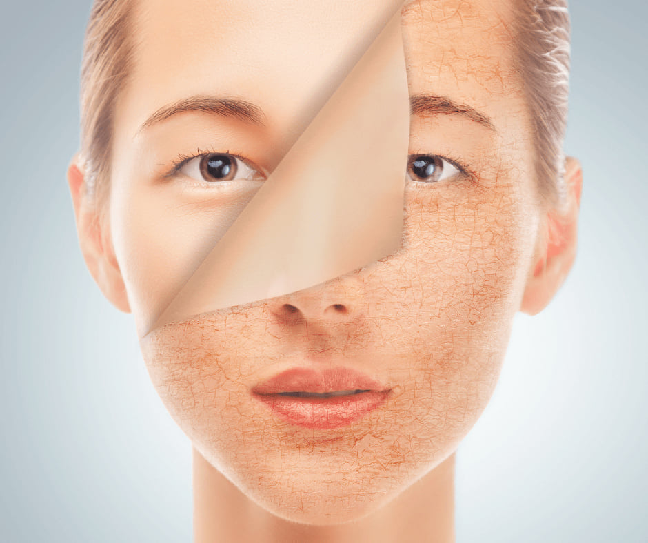 Peeling-ul chimic la Salon Glowartist