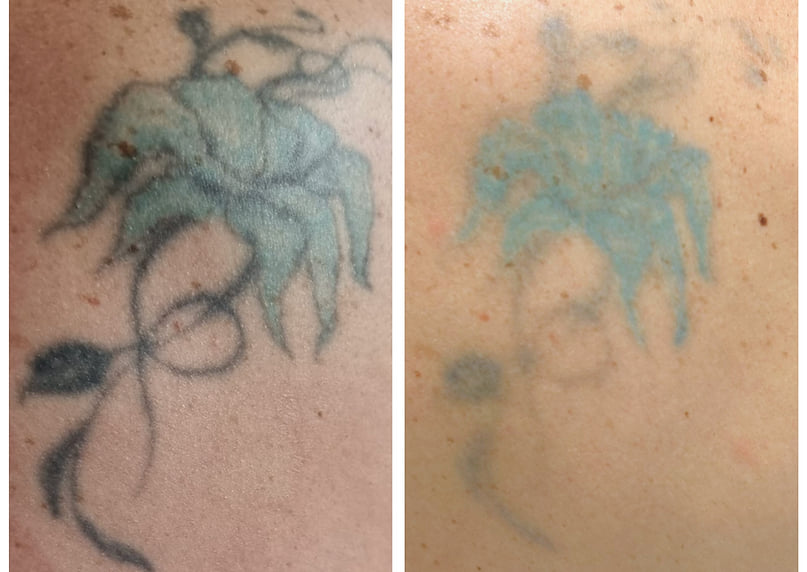Metodele de îndepărtare tatuaje colorate sau negre
