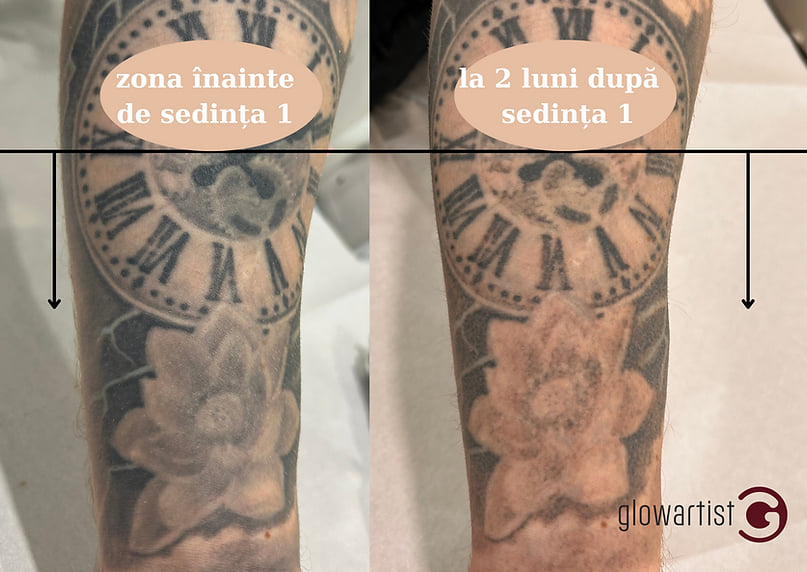 Metodele de îndepărtare a tatuajelor
